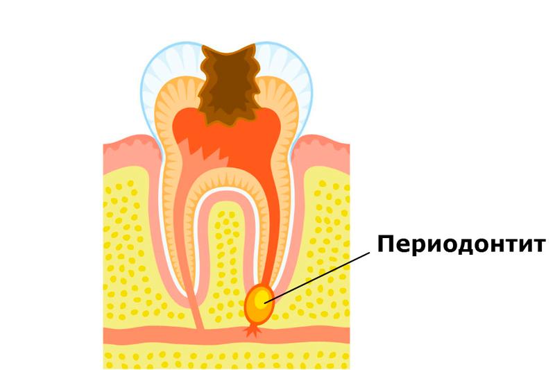 Периодонтит