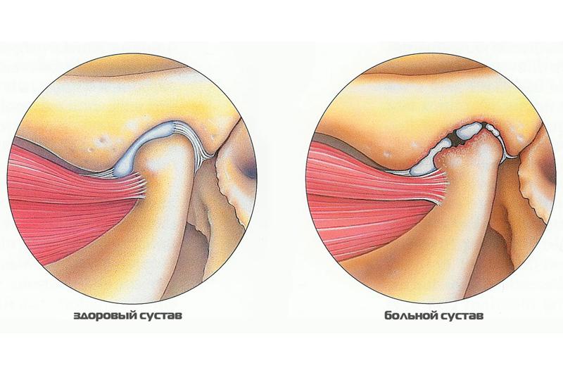 Артрит ВНЧС