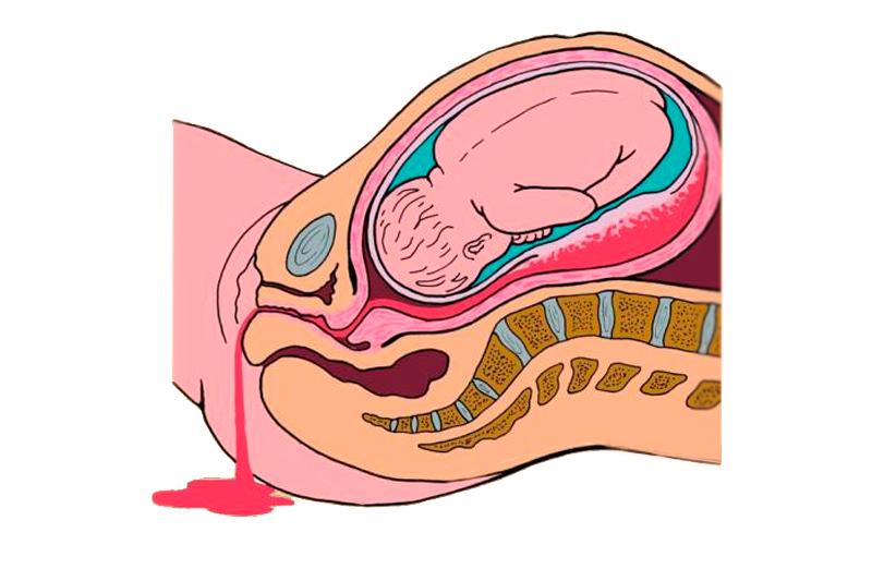 Преждевременная отслойка плаценты