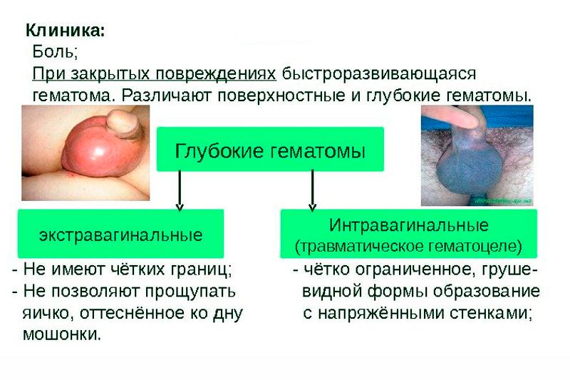 Травмы органов мошонки