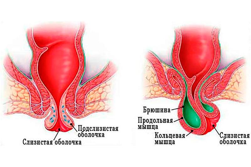 Выпадение прямой кишки