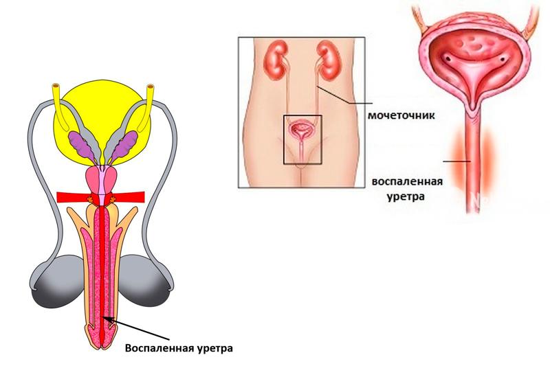 Что такое бактериальный уретрит: симптомы, диагностика, лечение