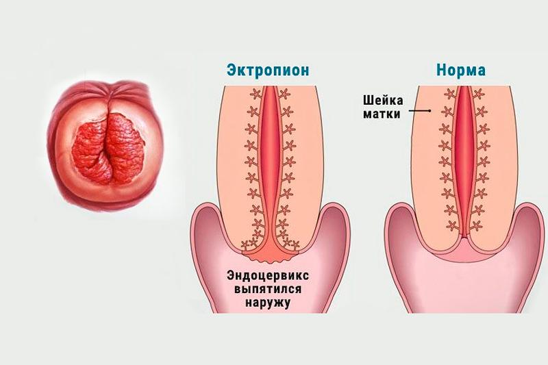 Эктропион шейки матки Эктропион шейки матки