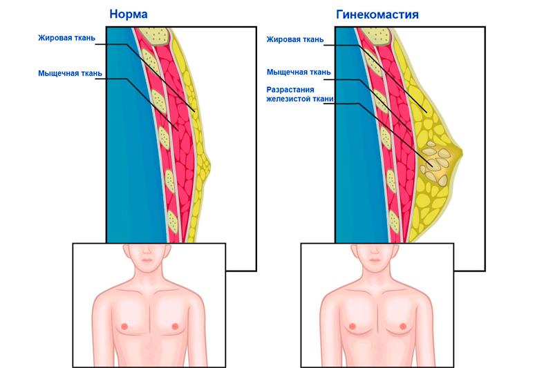 Гинекомастия