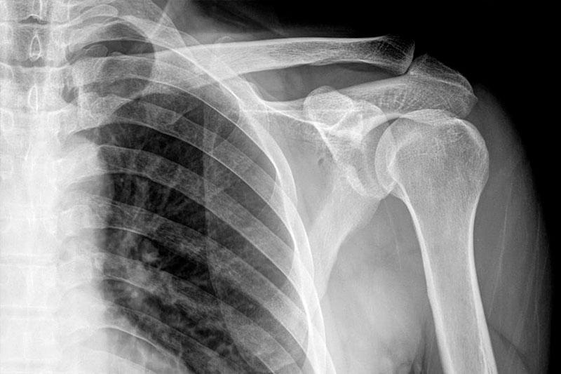Рентген костей предплечья