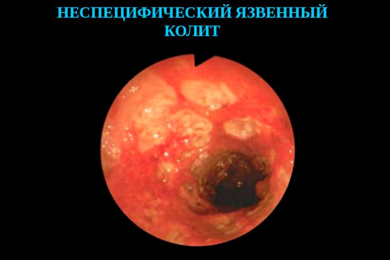 Неспецифический язвенный колит Неспецифический язвенный колит
