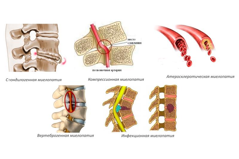 Миелопатия
