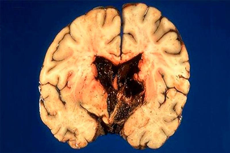 Кровоизлияние в желудочки головного мозга thumbnail