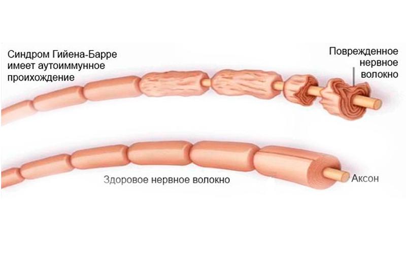 Синдром Гийена Синдром Гийена