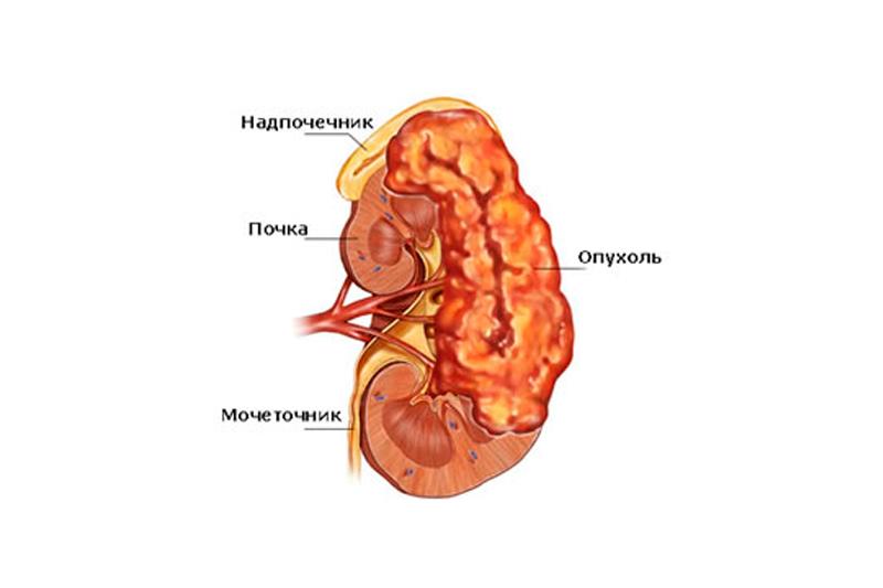 Опухоль надпочечников