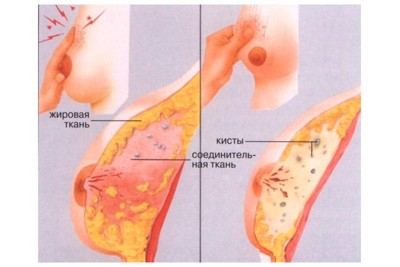 Жировой некроз молочной железы