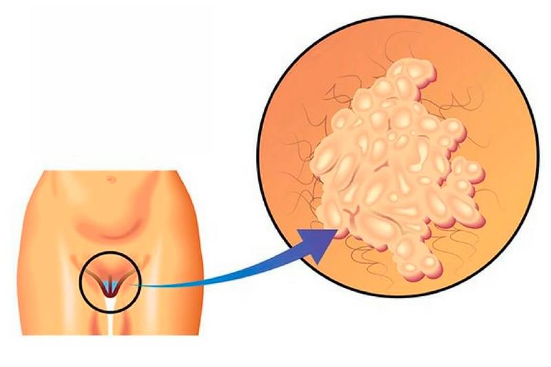 Новообразования вульвы