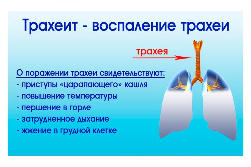 Симптомы и осложнени¤ трахеита thumbnail