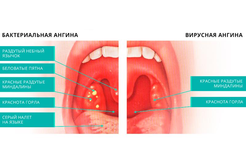 Ангина Ангина