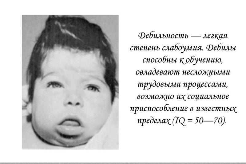 Дебильность Дебильность