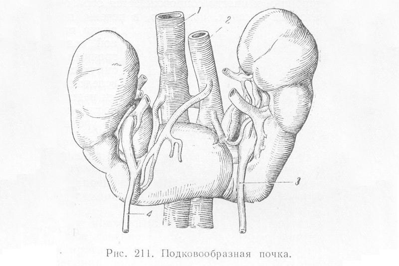Подковообразная почка Подковообразная почка
