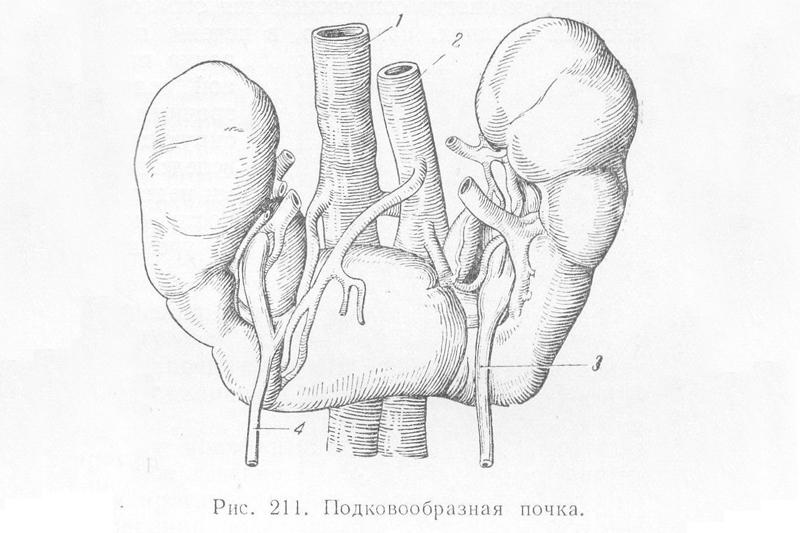 Подковообразная почка