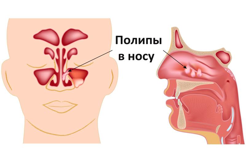 Полипы носа