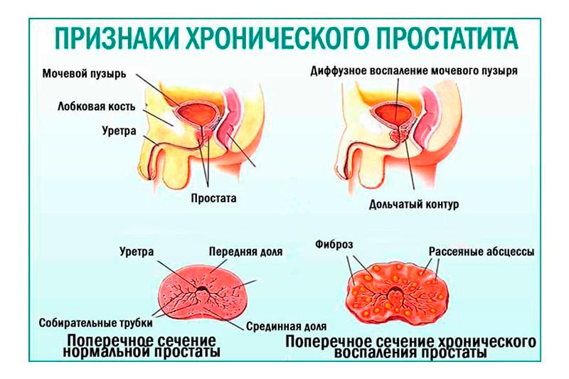 Хронический простатит