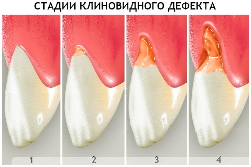 Клиновидный дефект зубов Клиновидный дефект зубов