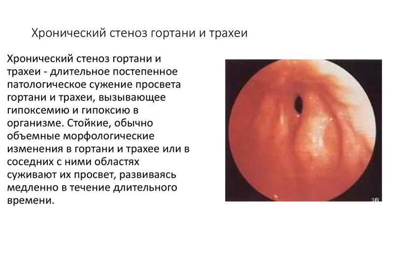 Хронический стеноз гортани Хронический стеноз гортани