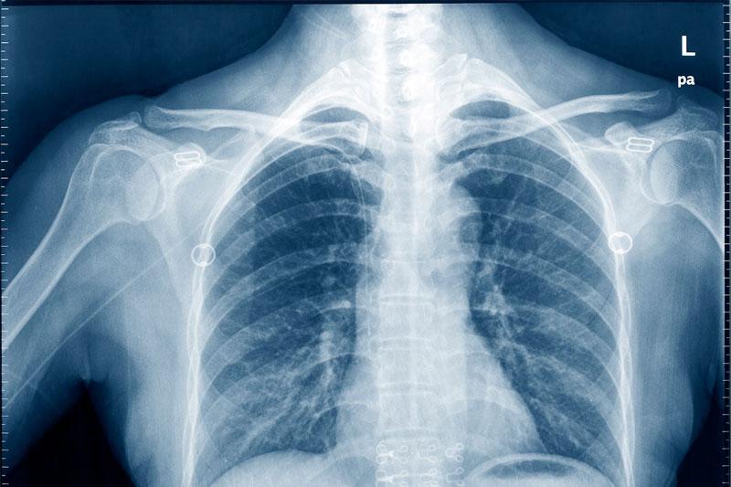 Рентген костей плеча