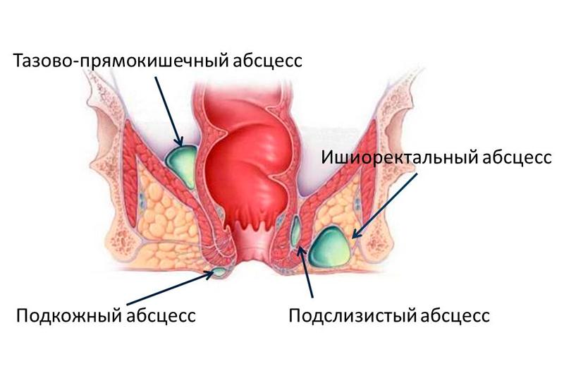 Парапроктит Парапроктит