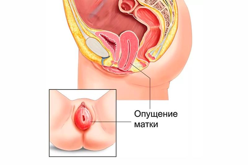 Опущение матки Опущение матки