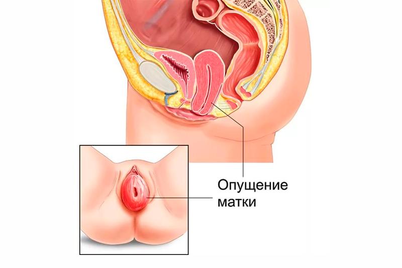 Опущение матки