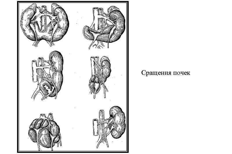 Сращение почек