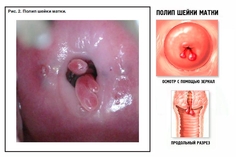 Полипы цервикального канала шейки матки