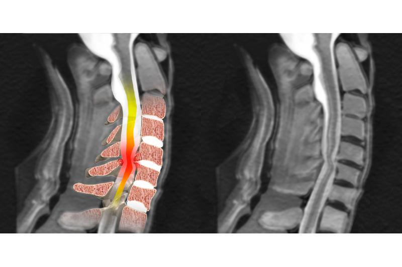 Сдавление спинного мозга в грудном отделе позвоночника thumbnail