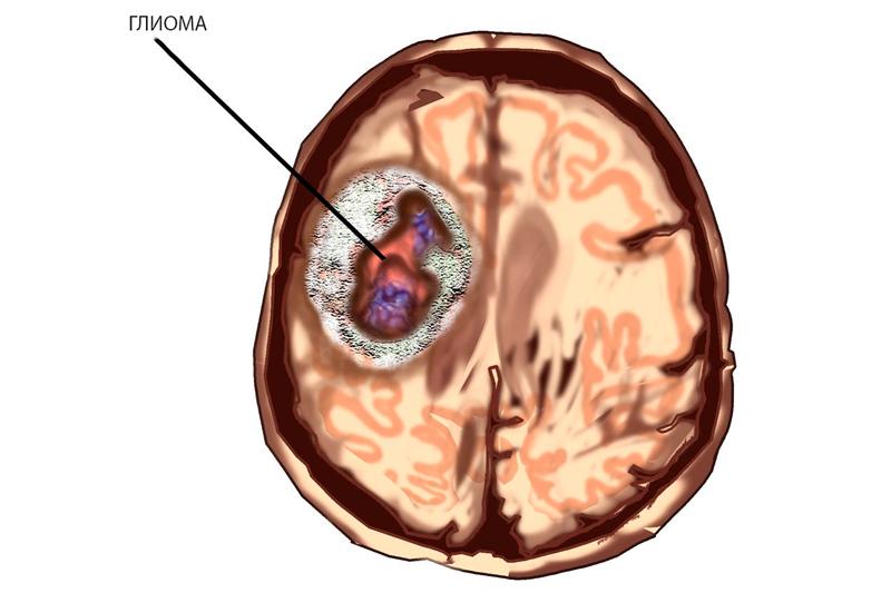 Глиома головного мозга