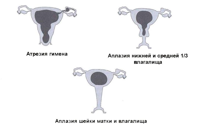Атрезия матки Атрезия матки