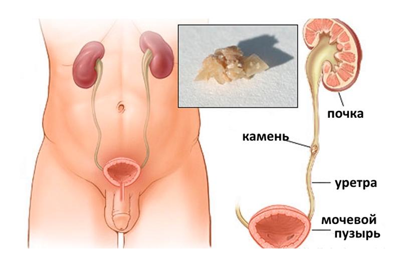 Камни мочеточника Камни мочеточника