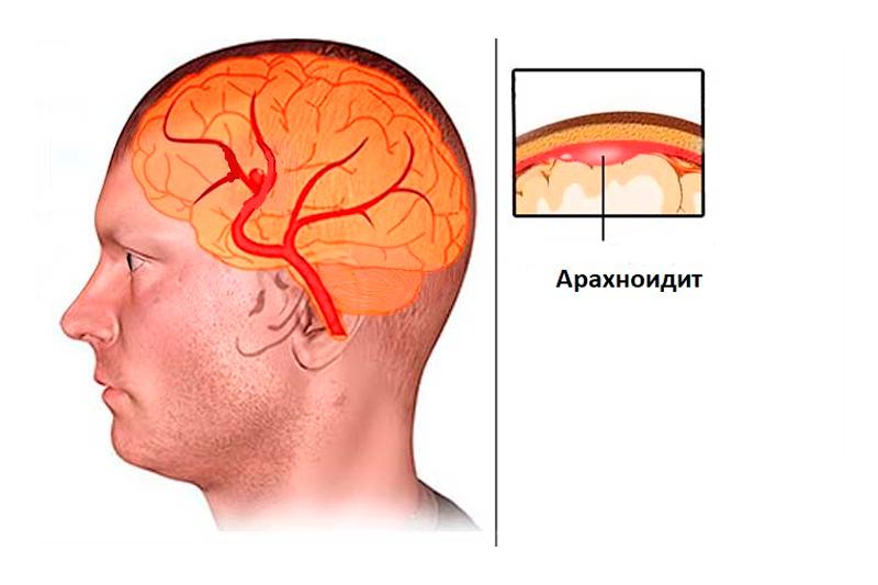 Доклад по теме Арахноидит