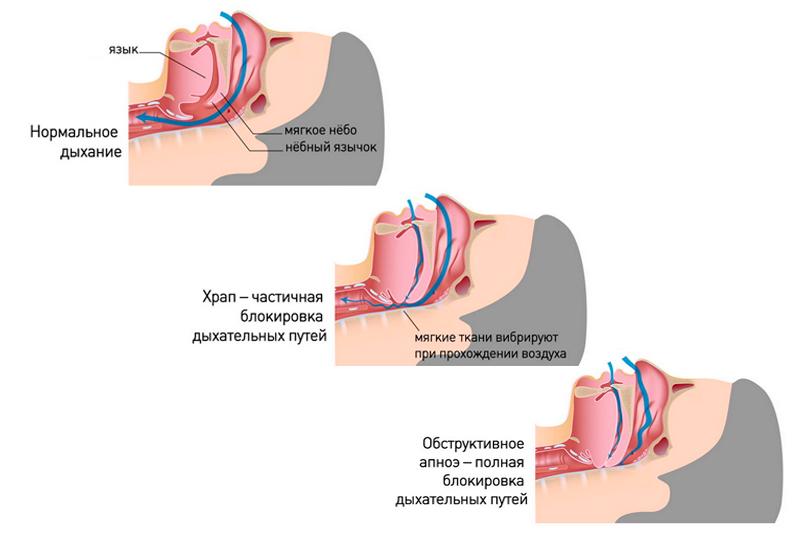 Доклад: Храп и апноэ