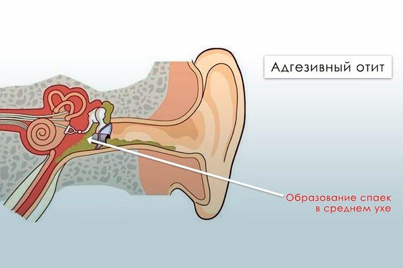 Адгезивный средний отит