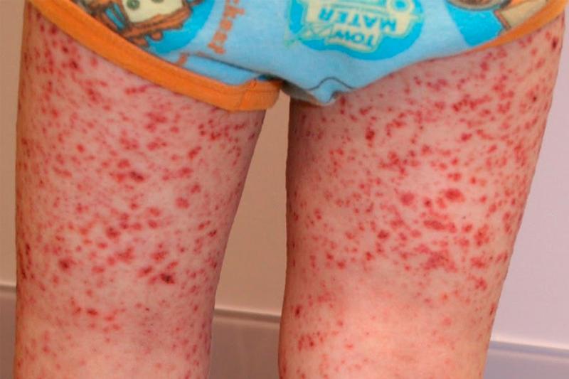 Полиморфный дермальный ангиит Полиморфный дермальный ангиит