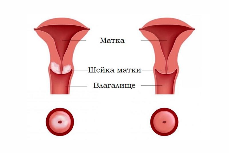 Лейкоплакия шейки матки Лейкоплакия шейки матки