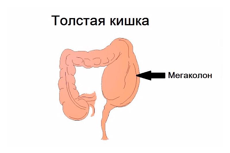 Мегаколон