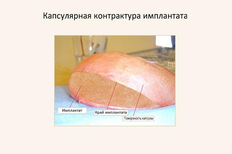 Капсулярная контрактура Капсулярная контрактура