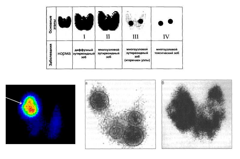 Диффузный нетоксичный. Токсическая аденома щитовидной железы сцинтиграфия. Узловой токсический зоб сцинтиграфия. Сцинтиграфия щитовидной железы диффузный токсический зоб. Сцинтиграфия щитовидной железы норма.