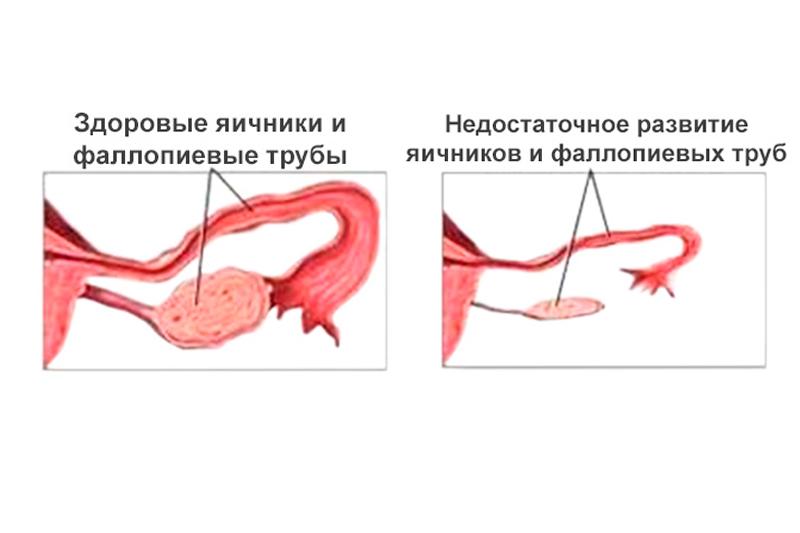 Гипоплазия яичников