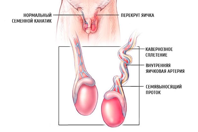 Перекрут яичка