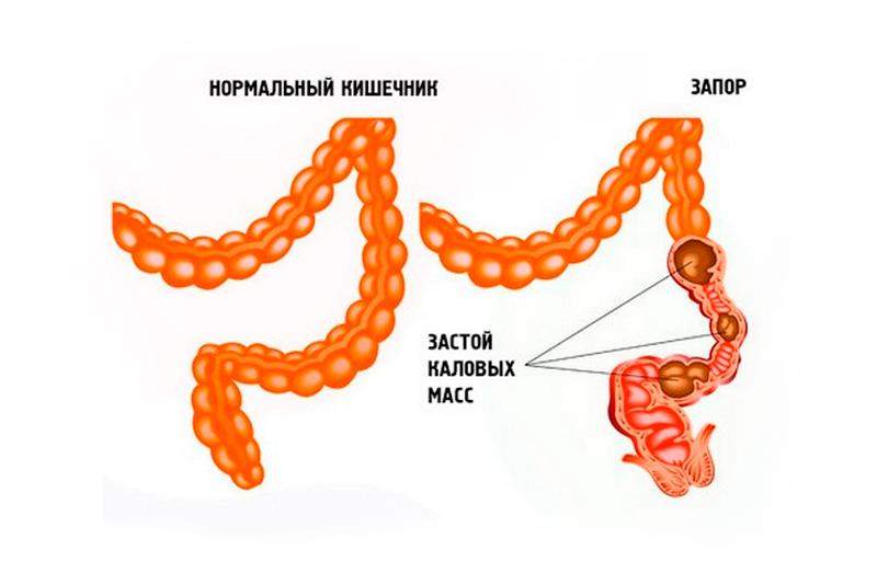 Запор