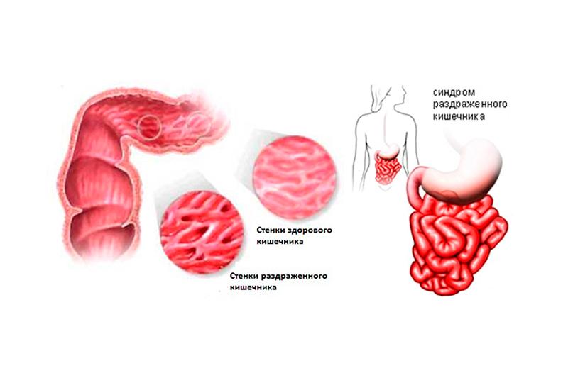 Лечение раздраженного кишечника у мужчин. Синдром раздражённого кишечника (СРК). Как выглядит кишечник при синдроме раздраженного кишечника. Симптом СРК раздраженного кишечника. Синдром раздраженного кишечника причины.