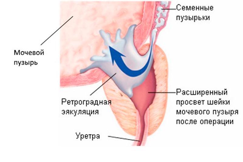 Ретроградная эякуляция