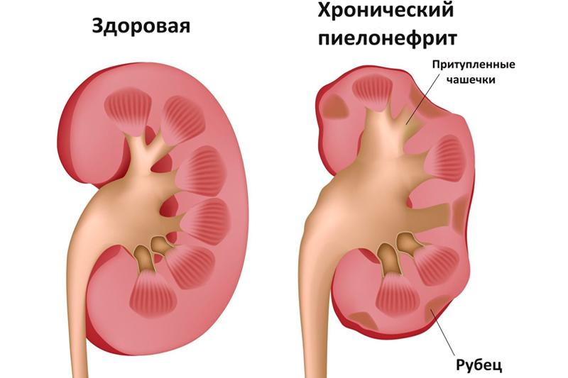 Хронический пиелонефрит