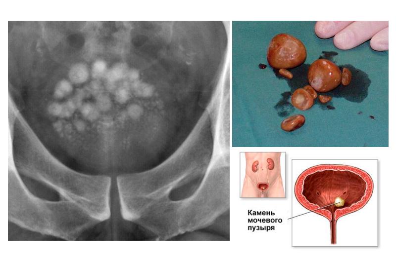 Камни в мочевом пузыре